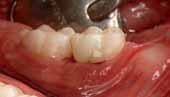 Лечение молочных зубов у детей стеклоиономерный цемент thumbnail