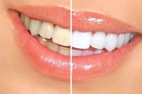 Использование наночастиц может стать лучшим способом отбеливания зубов