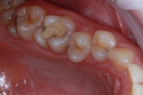 Прямая композитная реставрация жевательной группы зубов Enamel HRi