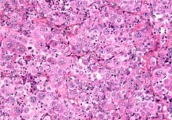 Раковая опухоль состоит из атипических полиэдрических крупных клеток с большим количеством эозинофильной цитоплазмы. Часть клеток содержит большие ядра и рельефные ядрышки (окраска гематоксилин-эозином, х20).