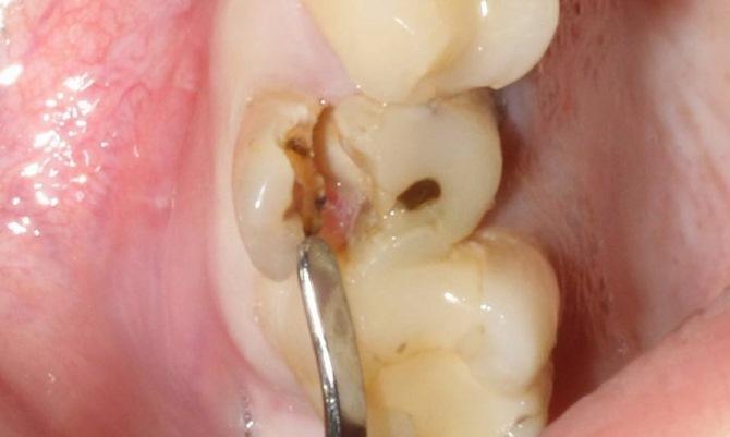 Немедленная имплантация и немедленная нагрузка в область 1.5 зуба