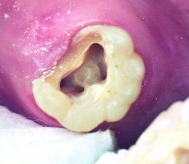 Большой коренной зуб верхней челюсти лечение thumbnail