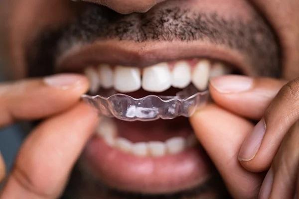 Лечение ортодонтического случая взрослого пациента с помощью применения метода выравнивания зубов прозрачными капами (элайнерами) врачом-стоматологом общей практики