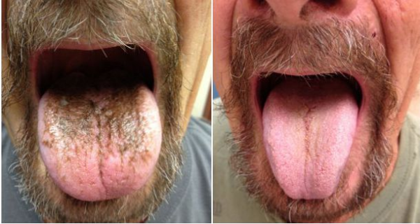Черный волосатый язык после антибиотиков