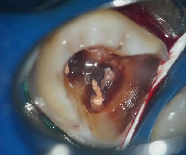 Эндодонтическое перелечивание зуба D3.6