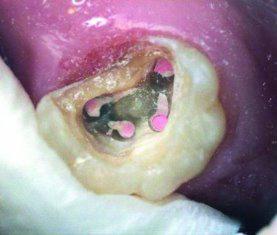 Диагноз и лечение вторых моляров верхней челюсти с двумя небными корнями (редкий клинический случай)