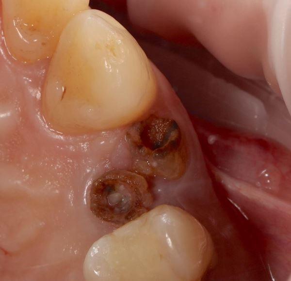 Одномоментная имплантация с немедленной нагрузкой в область зуба 14