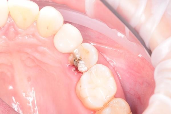 Важность использования коронок после эндодонтического лечения на примере зуба 2.5