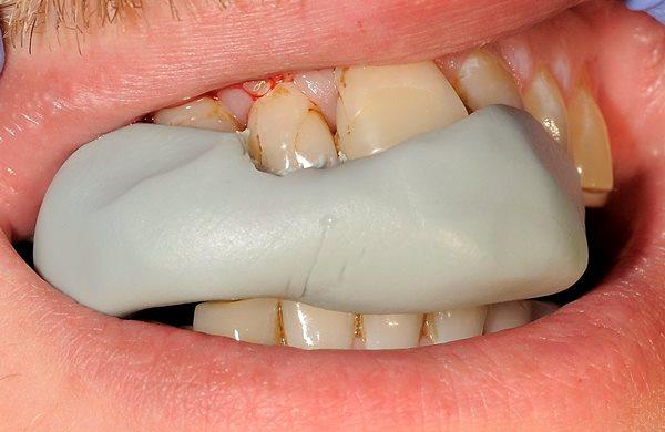 Реставрация 11 и 12 зуба с изменением вертикальной оси 11 зуба