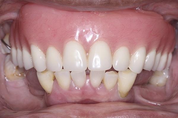 Немедленная нагрузка несъемного протеза полной зубной дуги с опорой на самозакручивающиеся имплантаты