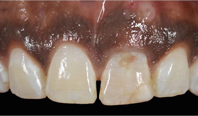 Концепция макроимплантата: парадигма восстановления области фронтальных зубов