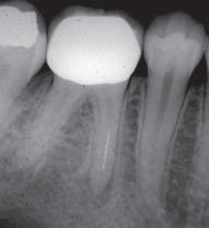Инструменты для повторного лечения каналов зуба