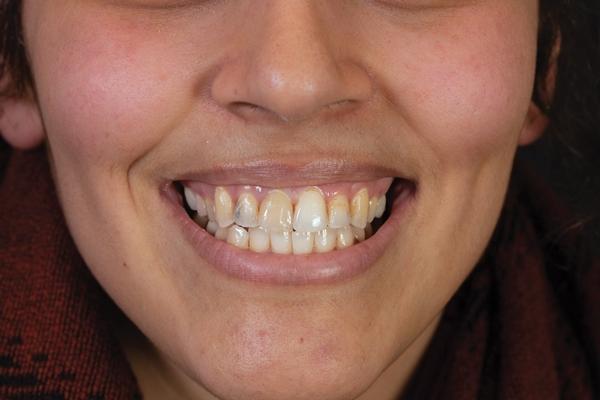 Одномоментная реставрация улыбки пациентки, испытывающей тревогу по поводу стоматологического вмешательства, с использованием технологии CAD/CAM и диоксида циркония с высокими эстетическими свойствами