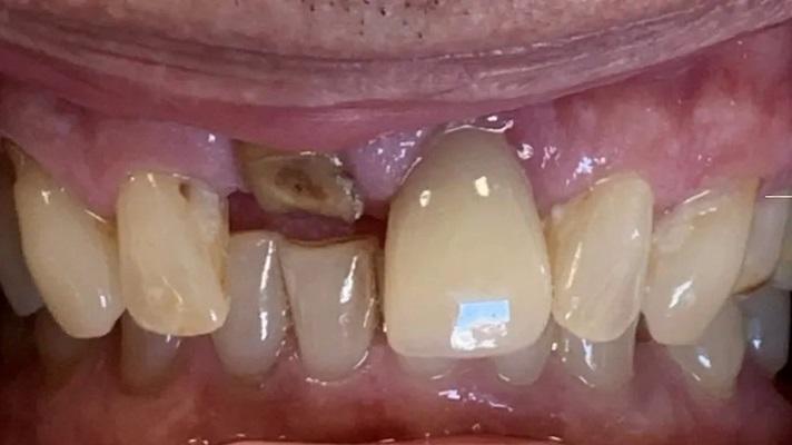 Упрощение немедленной установки имплантата и восстановления в зоне верхних передних зубов