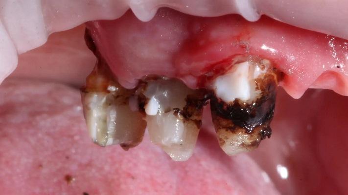 Комплексная стоматологическая реабилитация в цифровом рабочем процессе: тематическое исследование