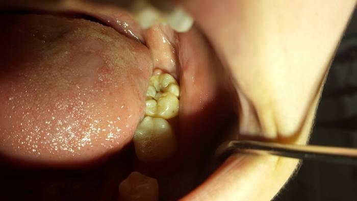 Лечение глубокого кариеса 38 зуба