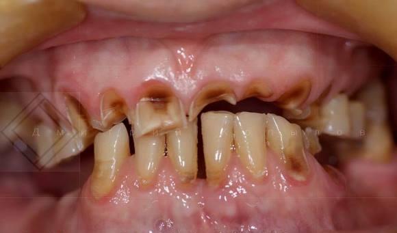 Реставрация витальных зубов композитом - качество адгезии к дентину