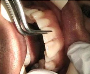 Специальная плёнка поможет в отбеливании зубов