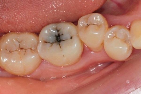 Лечение кариеса зубов 34, 35, 36, 37