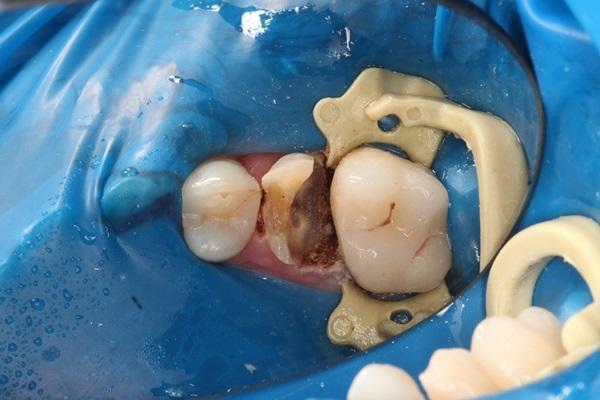 Протезирование зуба керамической коронкой по технологии CEREC без использования литого металлического культевого штифта или стекловолоконного штифта