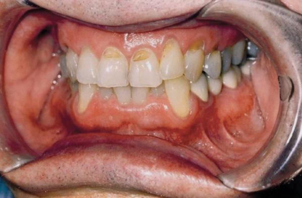 Происхождение и развитие гиперчувствительности цервикального дентина и не кариозных поражений шейки зуба: обзор литературы