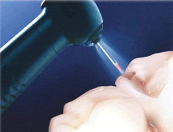 Сравнение лазерного и традиционного лечения зубов и влияние на поверхность и состав дентина