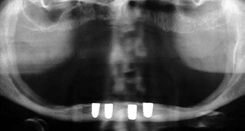 Перелом челюсти после имплантации
