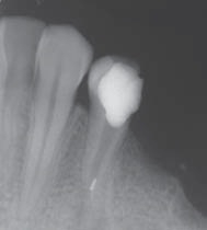 При лечении зуба в канале оставлен инструмент
