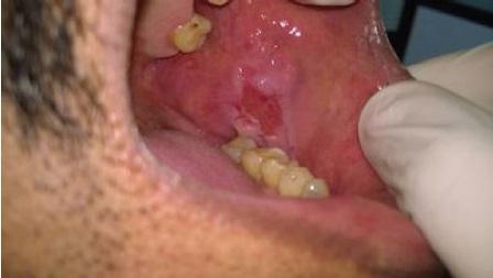 Повреждения слизистой оболочки полости рта: ключевые факторы в постановке диагноза пузырчатки вульгарной