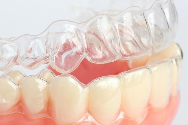 В США растет тенденция к выравниванию зубного ряда без обращения к ортодонту