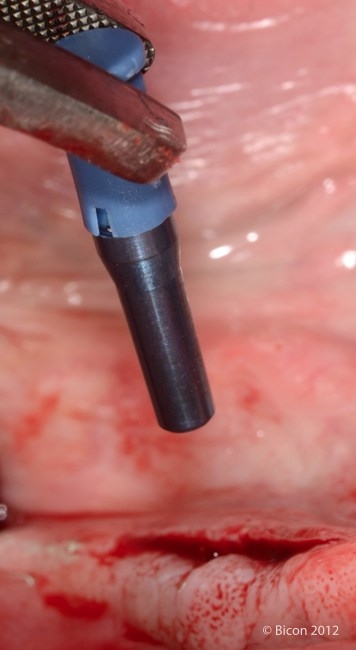 В канал импланта устанавливается синий 2,5 мм титановый оттискной штифт с акриловой накладкой.