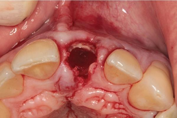 Технология сохранения объема лунки от удаленного зуба без использования костных блоков (период 5-летнего наблюдения ряда клинических случаев)