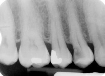Восстановление тканей зубов при лечении кариеса