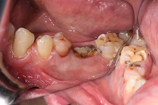 Одномоментная имплантация боковой группы зубов