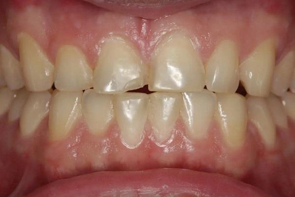 Консервативный и необходимый подход: как окклюзия может повлиять на замену одного зуба