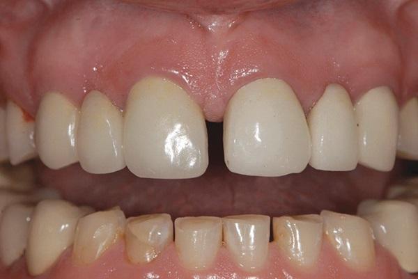 Интрузия зубов при ортодонтическом лечении