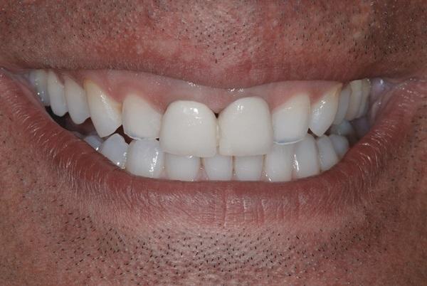 Десневая улыбка и синдром коротких зубов: этиопатогенез, классификация, критерии диагностики