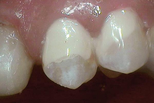 Стеклоиономерные цементы: материалы выбора в детской стоматологии