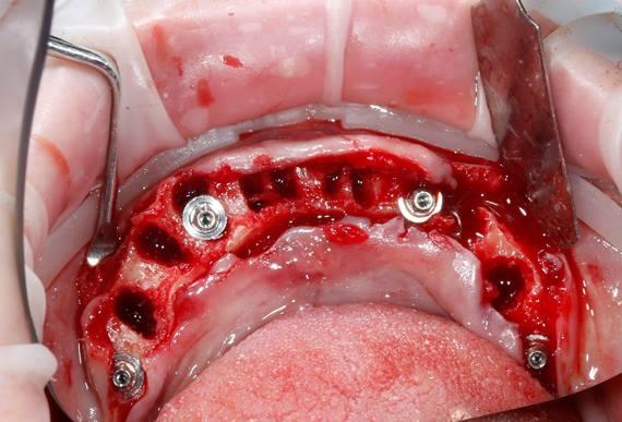 Немедленная имплантологическая реабилитация пациента после тотального удаления зубов по концепции "Weld-on-4"
