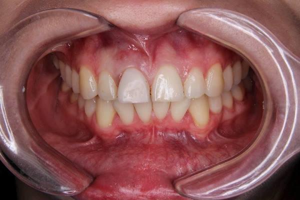 Форсированная экструзия как метод получения ферула и сохранения зуба