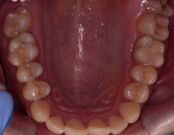 Этапность восстановления боковых зубов при втором классе