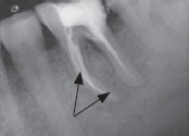 При лечении зуба сломался инструмент в зубе