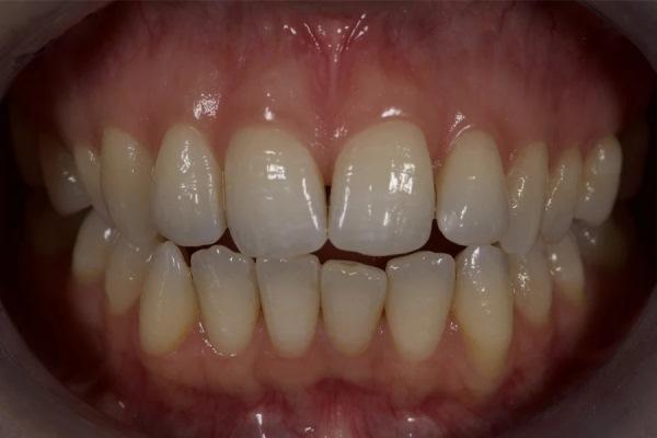 Фациально-ориентированное планирование лечения с учетом дыхательных путей (ФОПЛДП) при сложных случаях переднего открытого прикуса с интеграцией скрининга дыхательных путей, ФОПЛ, элайнер-терапии и скелетной опоры