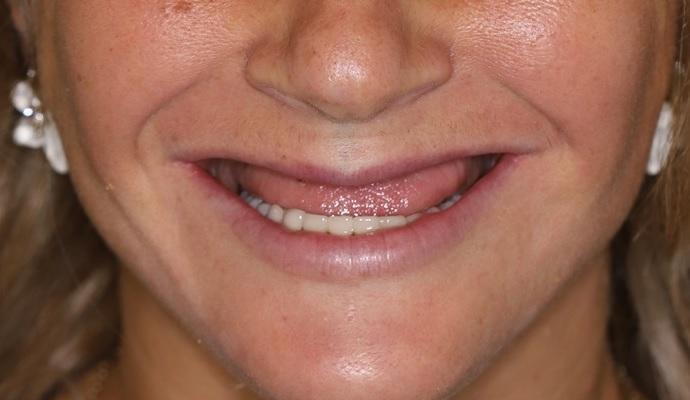 Тотальное протезирование зубов из диоксида циркония с помощью 8 имплантатов на верхней челюсти