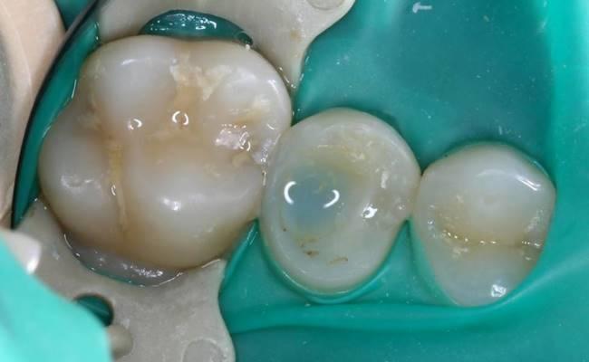 Эндо-ресто лечение зуба 2.5