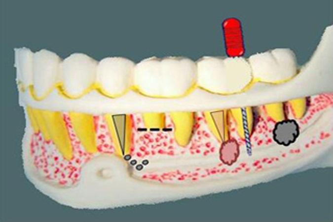 Лечение парестезии зубов и губы