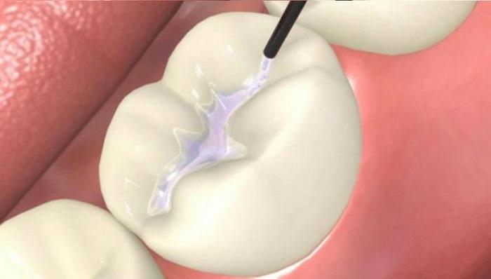 Исследование безопасности состава зубных силантов
