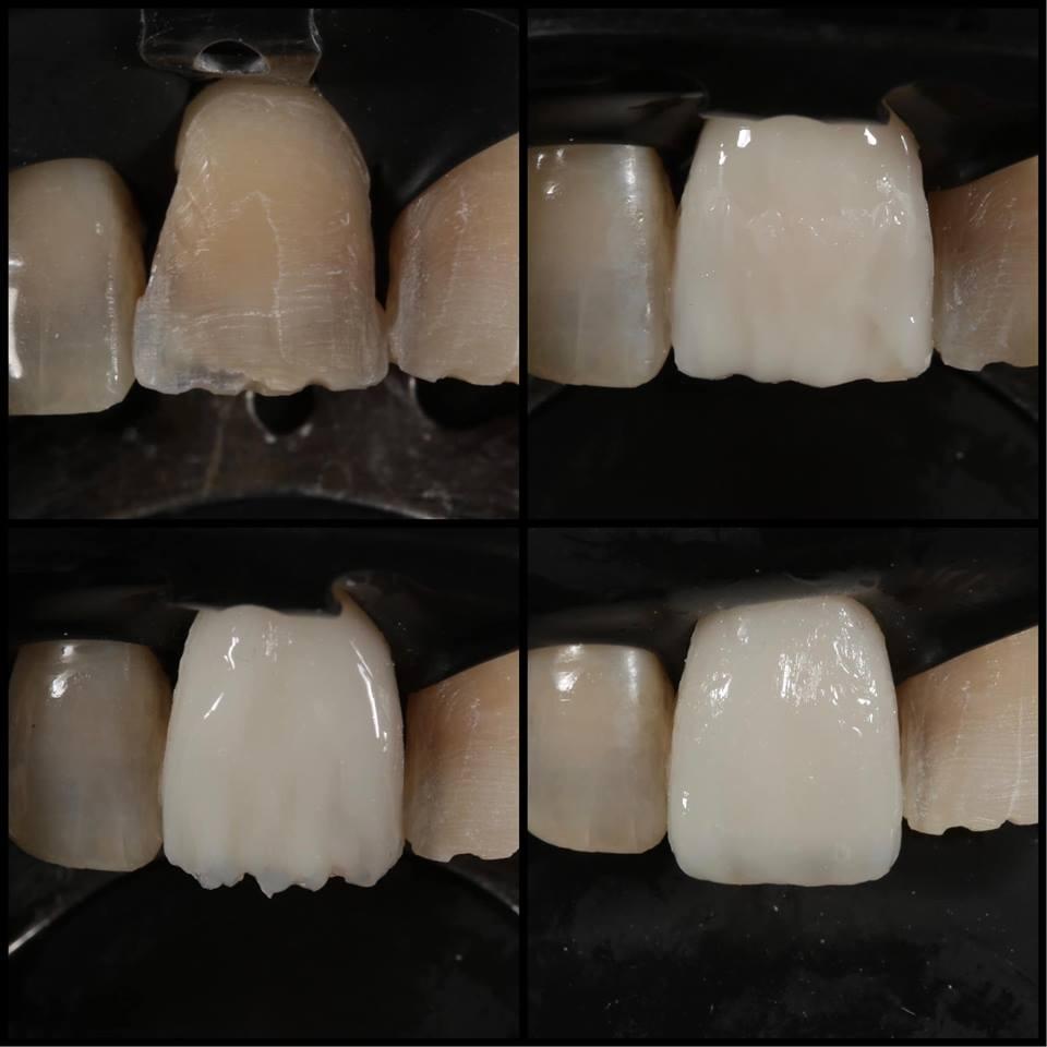 Зубная реставрация. Художественное наращивание зубов. Художественное восстановление зубов. Восстановление фронтальных зубов.