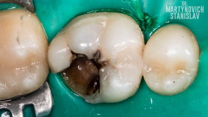 Структурно-функциональное восстановление зуба 46 керамической накладкой после первичного эндодонтического лечения в 2 визита