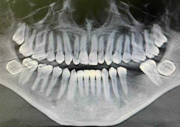 Рентгеновский снимок показывает редкие горизонтально ретинированные коренные зубы мужчины